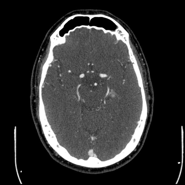 File:Acute A3 occlusion with ACA ischemic penumbra (CT perfusion) (Radiopaedia 72036-82527 Axial C+ arterial phase thins 98).jpg