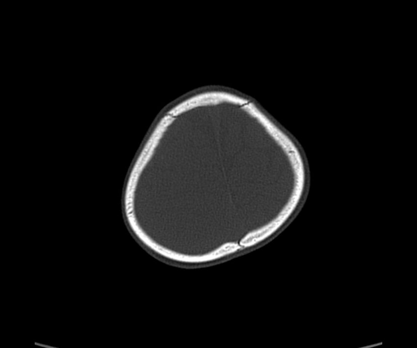Acute hemorrhagic contusion (Radiopaedia 63660-72336 Axial bone window 59).jpg