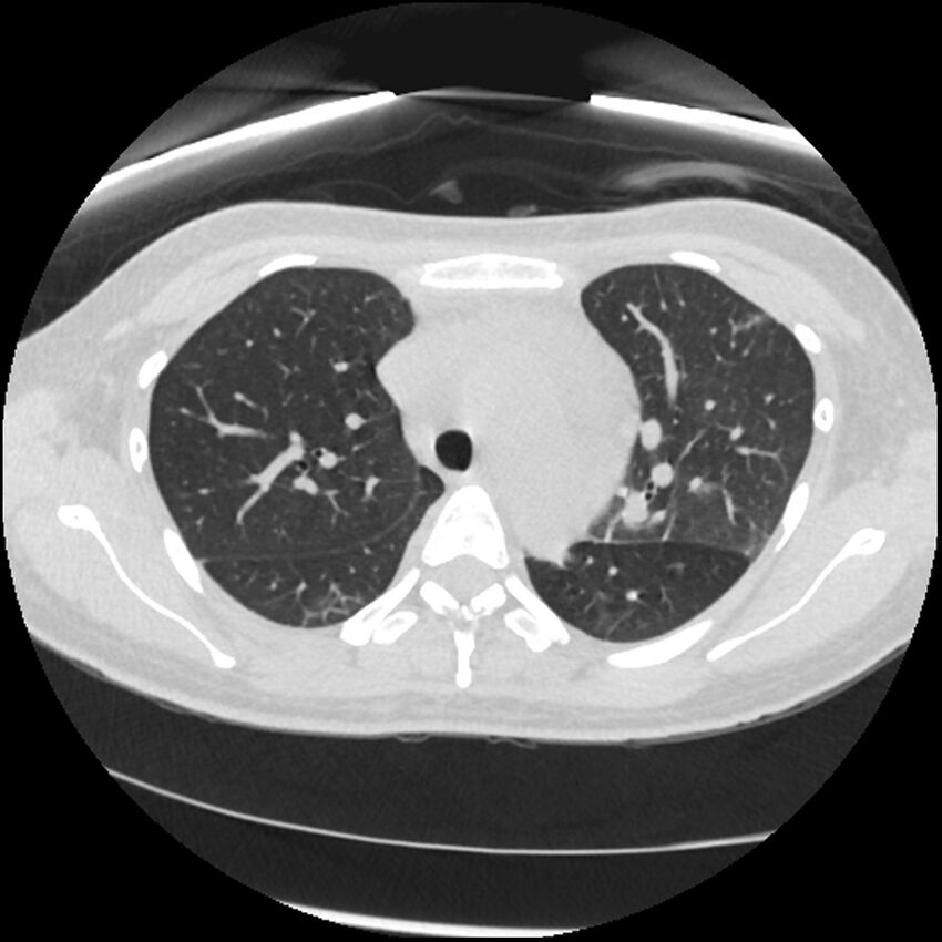 Acute lupus nephritis (Radiopaedia 45832-50107 Axial lung window 28).jpg