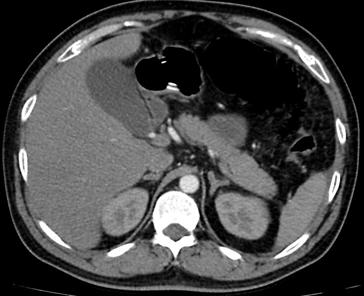File:Acute mesenteric ischemia - superior mesenteric artery thrombosis (Radiopaedia 73947-84776 Axial C+ arterial phase 10).jpg