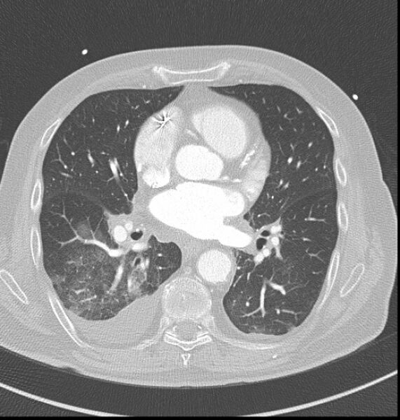 File:Acute myocardial infarction (Radiopaedia 23413-23481 lung window 34).jpg