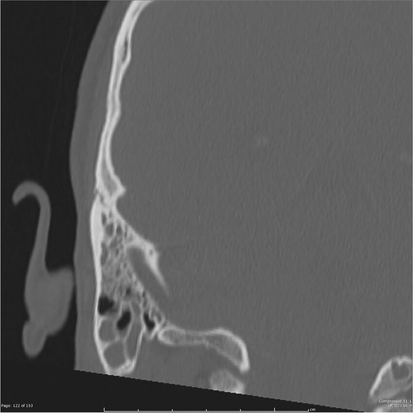 Acute otomastoiditis (Radiopaedia 28276-28512 Coronal PTB bone window reformat 53).jpg