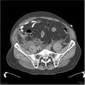 Acute pancreatitis (Radiopaedia 19135-19116 Axial non-contrast 46).jpg