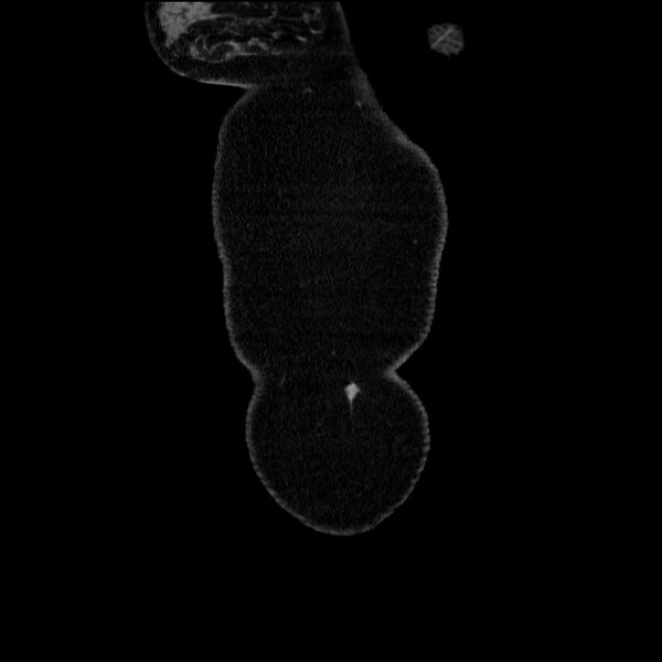 File:Acute pancreatitis (Radiopaedia 69236-79012 Coronal C+ portal venous phase 70).jpg