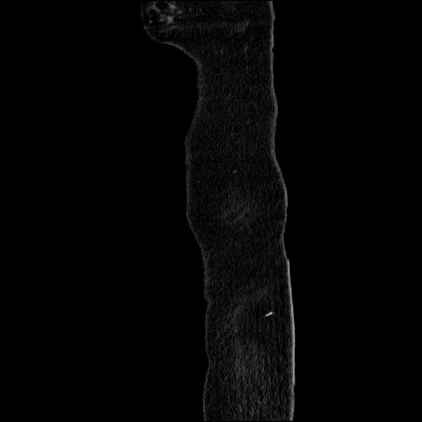 File:Acute pancreatitis (Radiopaedia 69236-79012 Sagittal C+ portal venous phase 94).jpg