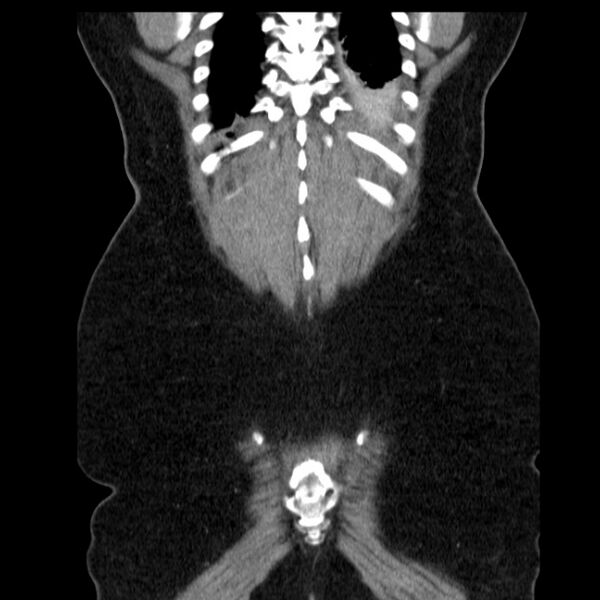 File:Acute pancreatitis - Balthazar C (Radiopaedia 26569-26714 Coronal C+ portal venous phase 61).jpg