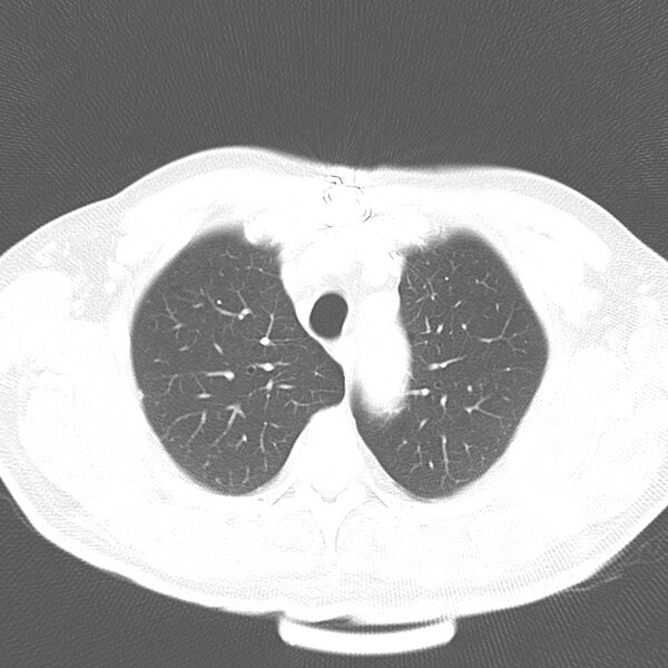 File:Acute pulmonary embolism (Radiopaedia 81677-95570 Axial lung window 9).jpg