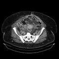 Acute pyelonephritis (Radiopaedia 25657-25837 Axial renal parenchymal phase 61).jpg