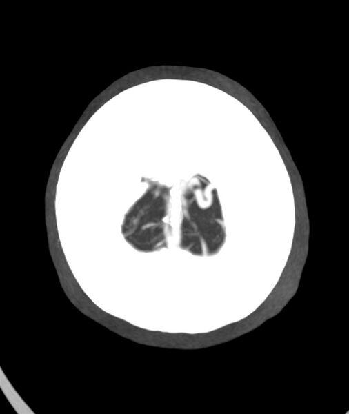 File:Acute right MCA M1 occlusion (Radiopaedia 62268-70454 Axial Phase 2 1).jpg