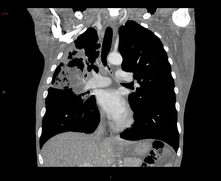 File:Acute right lung abscess (Radiopaedia 34806-36258 Coronal C+ arterial phase 30).jpg