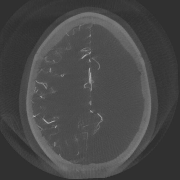 File:Acute subarachnoid hemorrhage and accessory anterior cerebral artery (Radiopaedia 69231-79010 Axial arterial - MIP 61).jpg