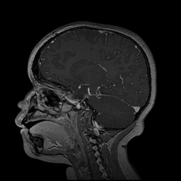 File:Adamantinomatous craniopharyngioma (Radiopaedia 77407-89529 H 72).jpg