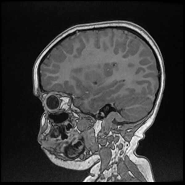 File:Adamantinomatous craniopharyngioma (Radiopaedia 77407-89529 Sagittal T1 C+ 41).jpg