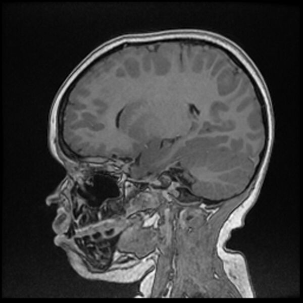 File:Adamantinomatous craniopharyngioma (Radiopaedia 77407-89529 Sagittal T1 C+ 50).jpg