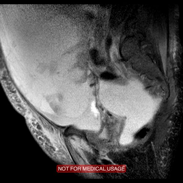 File:Adenocarcinoma of the cervix (Radiopaedia 28373-28615 Sagittal T2 fat sat 4).jpg