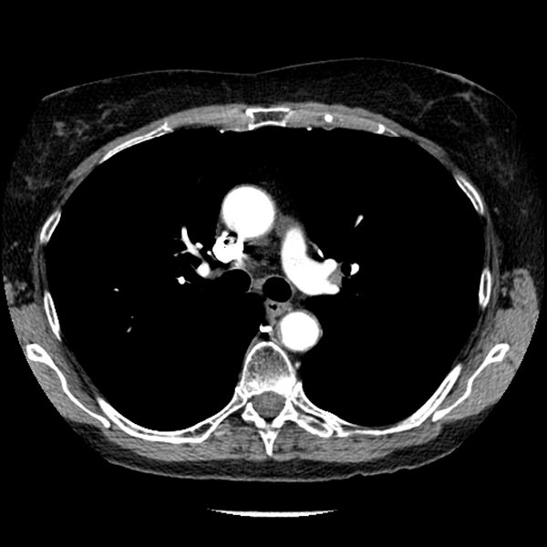 File:Adenocarcinoma of the lung (Radiopaedia 41015-43755 Axial C+ portal venous phase 47).jpg