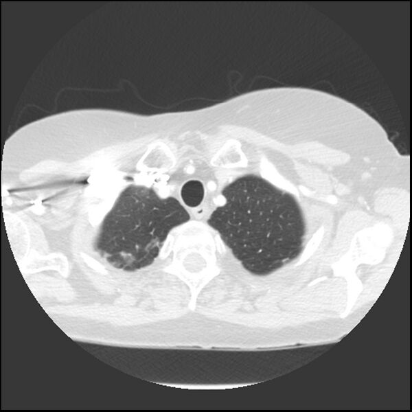 File:Adenocarcinoma of the lung (Radiopaedia 41015-43755 Axial lung window 15).jpg