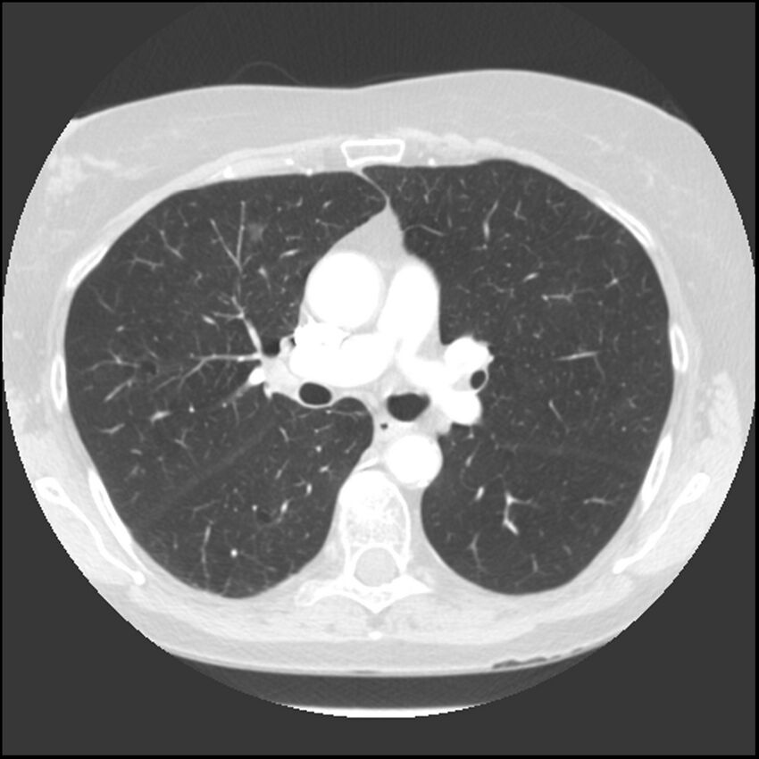 Adenocarcinoma of the lung (Radiopaedia 41015-43755 Axial lung window 52).jpg