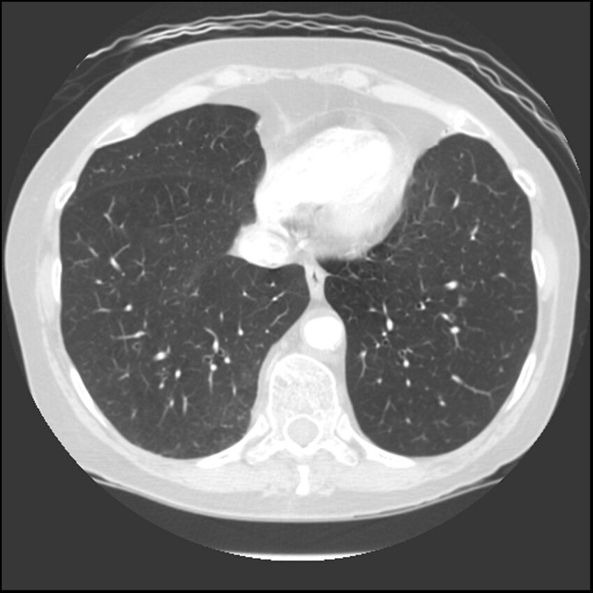 Adenocarcinoma of the lung (Radiopaedia 41015-43755 Axial lung window 93).jpg