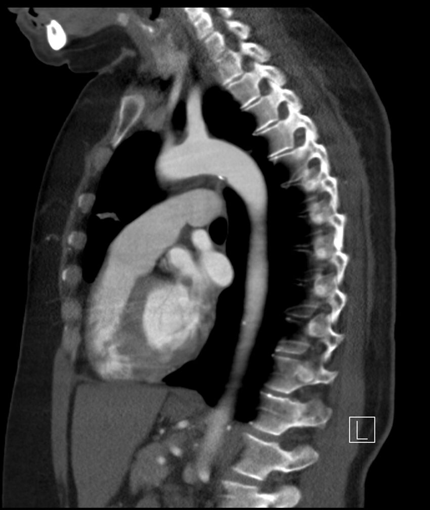 Adenocarcinoma of the lung (Radiopaedia 44205-47803 Sagittal C+ portal venous phase 25).jpg