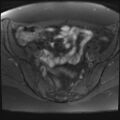 Adenomyosis and endometriotic cysts (Radiopaedia 82300-96367 Axial T1 fat sat 23).jpg