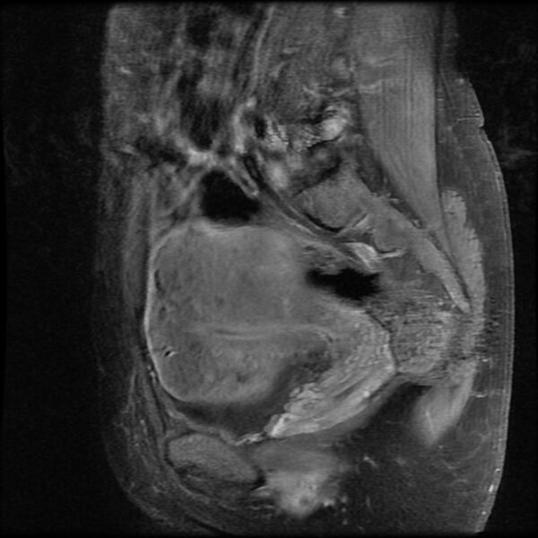 File:Adenomyosis on MRI (Radiopaedia 29328-29780 Sagittal T1 C+ fat sat 12).jpg