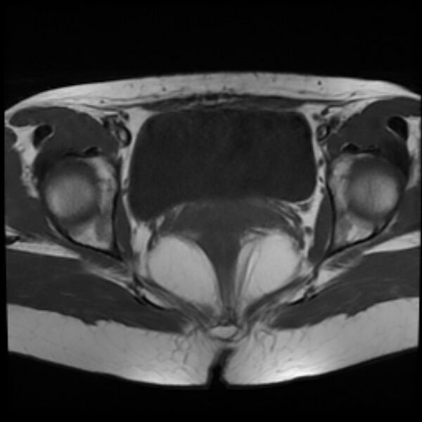 File:Adenomyosis within a septate uterus (Radiopaedia 69963-79981 Axial T1 20).jpg