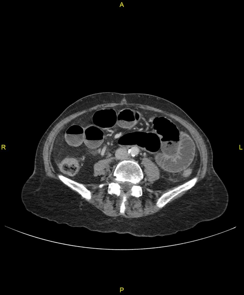 Adhesional small bowel obstruction (Radiopaedia 85402-101024 Axial C+ portal venous phase 168).jpg