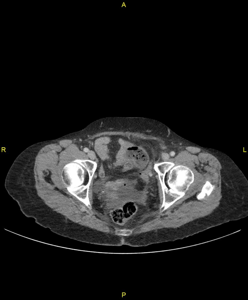 Adhesional small bowel obstruction (Radiopaedia 85402-101024 Axial C+ portal venous phase 267).jpg