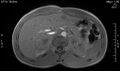Adrenal pheochromocytoma (Radiopaedia 35133-36730 Axial T1 out-of-phase 5).jpg