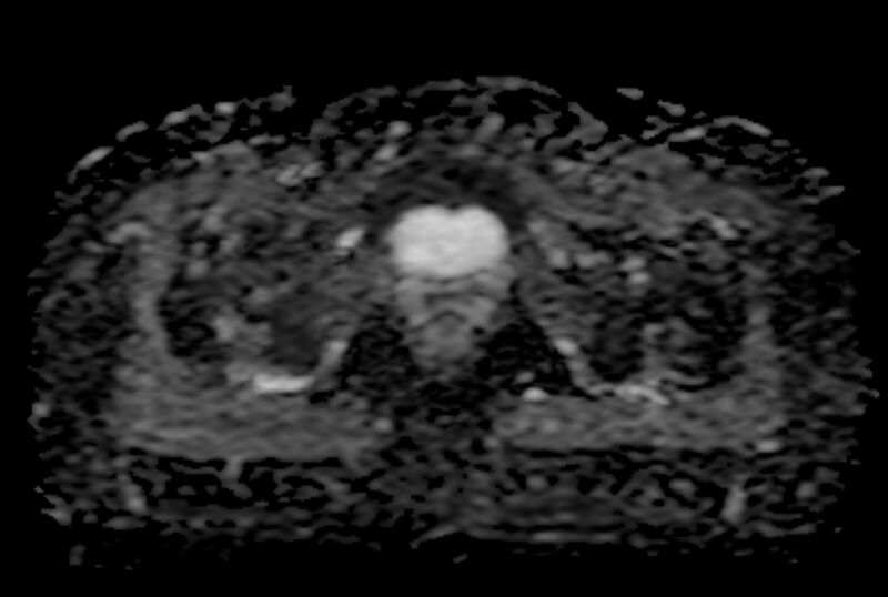 File:Adult granulosa cell tumor of the ovary (Radiopaedia 71581-81950 Axial ADC 23).jpg
