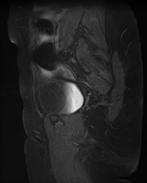 File:Adult granulosa cell tumor of the ovary (Radiopaedia 71581-81950 Sagittal T1 C+ fat sat 6).jpg