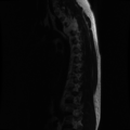 Aggressive vertebral hemangioma (Radiopaedia 39937-42404 Sagittal T2 4).png