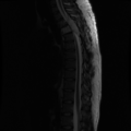 Aggressive vertebral hemangioma (Radiopaedia 39937-42404 Sagittal T2 8).png