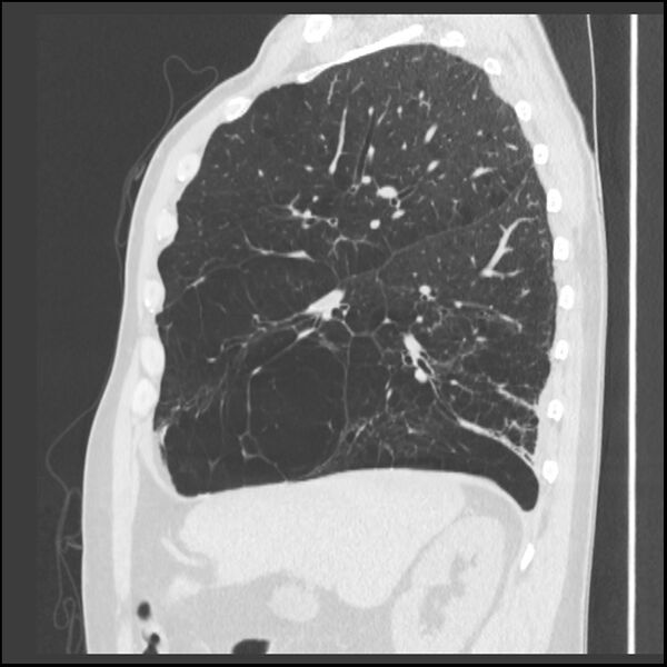 File:Alpha-1-antitrypsin deficiency (Radiopaedia 40993-43722 Sagittal lung window 183).jpg