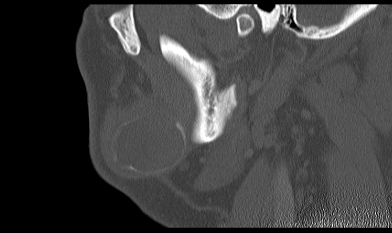 File:Ameloblastoma (Radiopaedia 33677-34806 Sagittal bone window 18).png