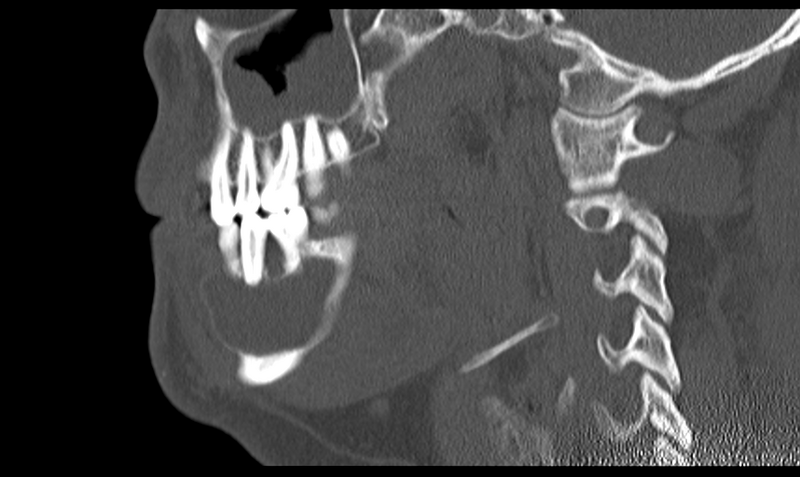 File:Ameloblastoma (Radiopaedia 33677-34806 Sagittal bone window 26).png