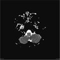 Amnestic syndrome secondary to hypoxic brain injury (Radiopaedia 24743-25004 ADC 6).jpg