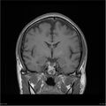 Amnestic syndrome secondary to hypoxic brain injury (Radiopaedia 24743-25004 B 15).jpg