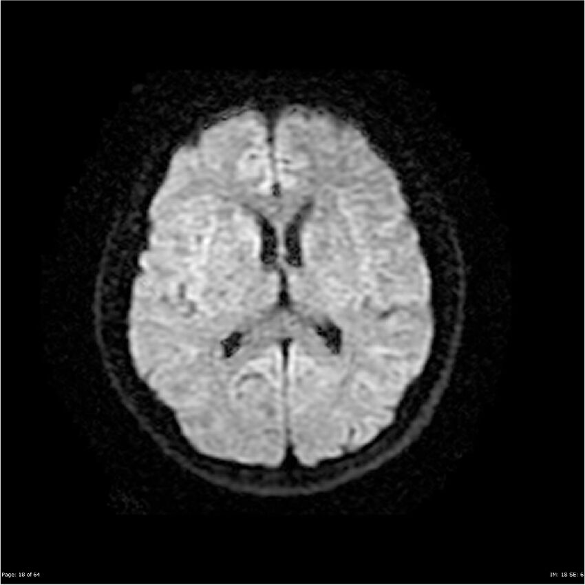 Amnestic syndrome secondary to hypoxic brain injury (Radiopaedia 24743-25004 DWI 18).jpg