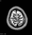 Amyotrophic lateral sclerosis (Radiopaedia 5373-7134 Axial T2 22).jpg