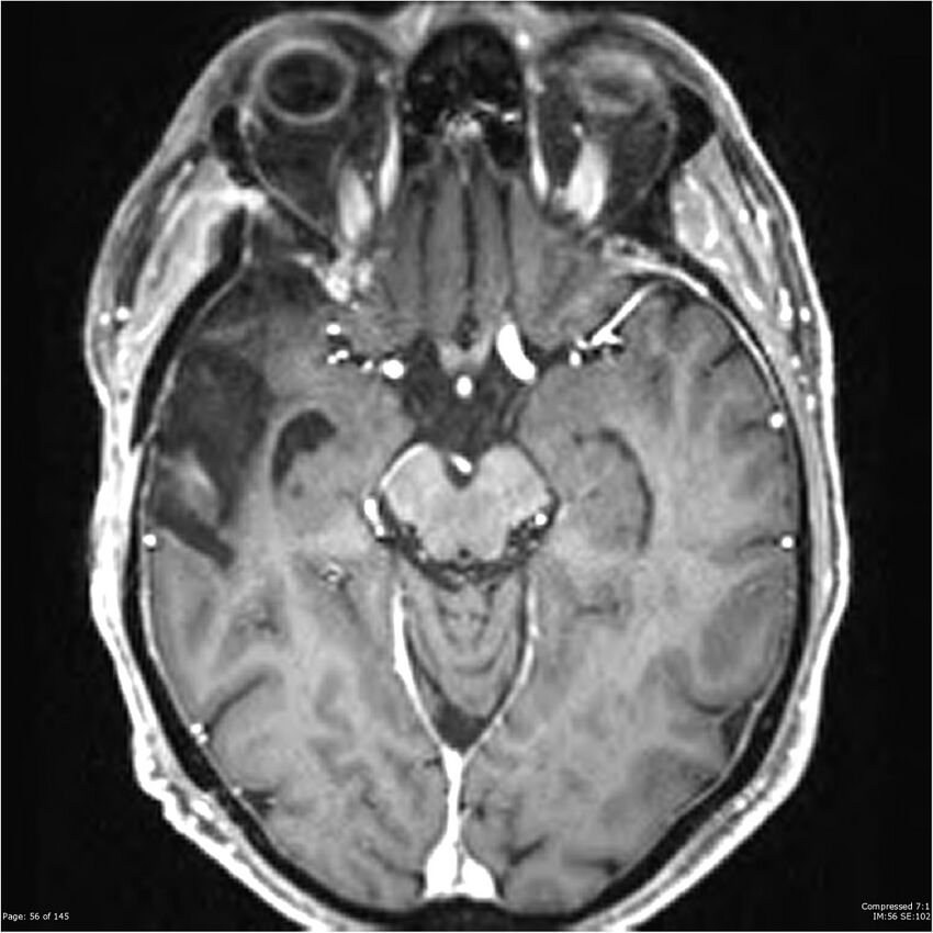 Anaplastic meningioma with recurrence (Radiopaedia 34452-35788 Axial T1 C+ 56).jpg