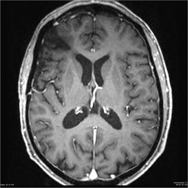 File:Anaplastic meningioma with recurrence (Radiopaedia 34452-35788 Axial T1 C+ 81).jpg
