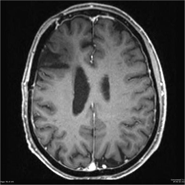 File:Anaplastic meningioma with recurrence (Radiopaedia 34452-35788 Axial T1 C+ 96).jpg