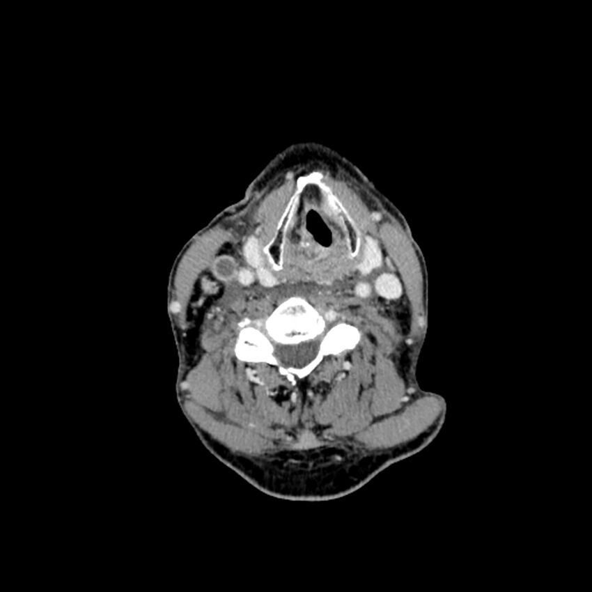 Anaplastic thyroid carcinoma (Radiopaedia 79087-92034 B 61).jpg