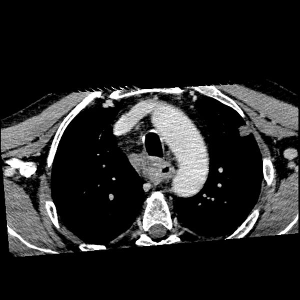 File:Anaplastic thyroid carcinoma (Radiopaedia 79087-92034 B 8).jpg