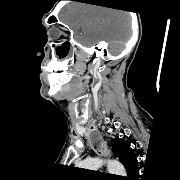 File:Anaplastic thyroid carcinoma (Radiopaedia 79087-92034 C 63).jpg