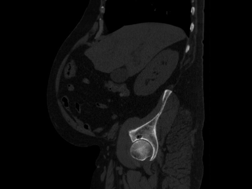 Ankylosing spondylitis (Radiopaedia 44609-48357 Sagittal bone window 22).jpg