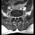 Ankylosing spondylitis with zygapophyseal arthritis (Radiopaedia 38433-40516 Axial T1 2).jpg