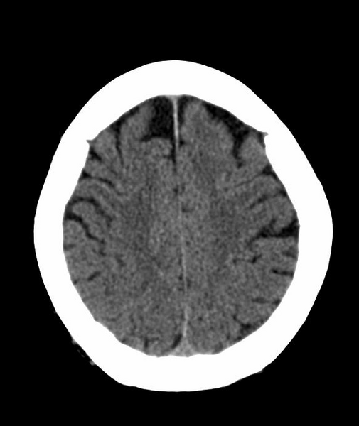 File:Anomalous intracranial venous drainage (Radiopaedia 28161-28418 Axial 42).png